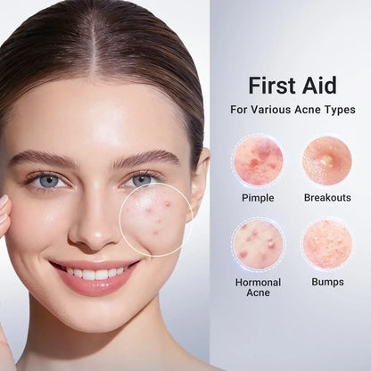 Dr.Leo Drying Lotion | Pimple Treatment & Body Acne Treatment | Visibly Shrinks Pimples in 24 Hours & Helps Fade Acne Marks in 7 Days | With 1.8% Encapsulated Salicylic Acid, 4% Niacinamide & 10% Sulfur (20ml) #mothersdaygift #Summervibes