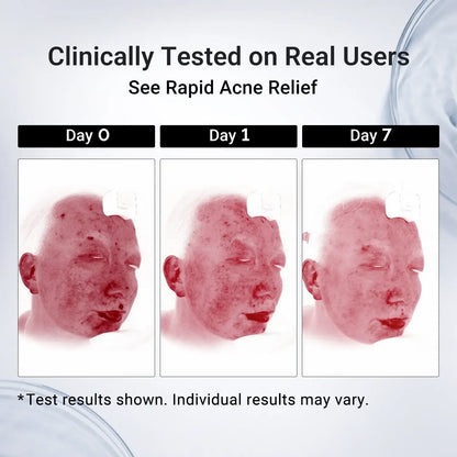 Dr.Leo Drying Lotion | Pimple Treatment & Body Acne Treatment | Visibly Shrinks Pimples in 24 Hours & Helps Fade Acne Marks in 7 Days | With 1.8% Encapsulated Salicylic Acid, 4% Niacinamide & 10% Sulfur (20ml) #mothersdaygift #Summervibes