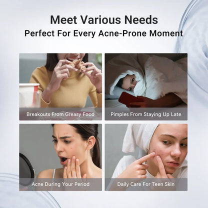 Dr.Leo Drying Lotion | Pimple Treatment & Body Acne Treatment | Visibly Shrinks Pimples in 24 Hours & Helps Fade Acne Marks in 7 Days | With 1.8% Encapsulated Salicylic Acid, 4% Niacinamide & 10% Sulfur (20ml) #mothersdaygift #Summervibes